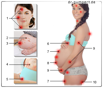 Schematische Darstellung von Hautausschlag in der Schwangerschaft