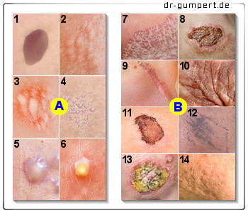 Schematische Darstellung von Hautveränderungen