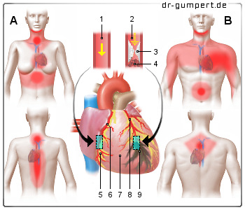 Schematische Darstellung eines Herzinfarktes