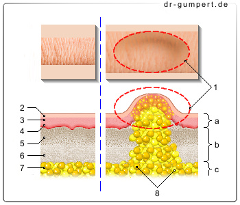 Schematische Darstellung eines Lipoms