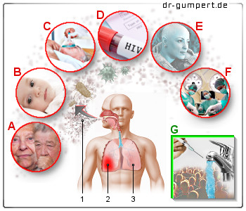 Schematische Darstellung einer Lungenentzündung