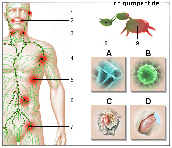 Schematische Darstellung einer Lymphknotenschwellung