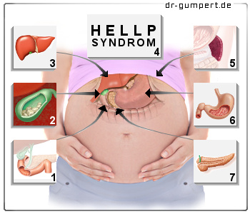 Schematische Darstellung Oberbauchschmerzen in der Schwangerschaft