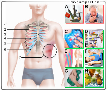 Vom husten rippenprellung Rippenprellung