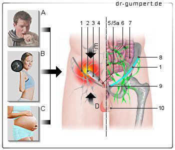 Schematische Darstellung von Leistenschmerzen