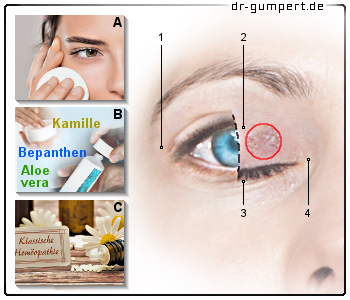 Schematische Darstellung trockene Augenlider