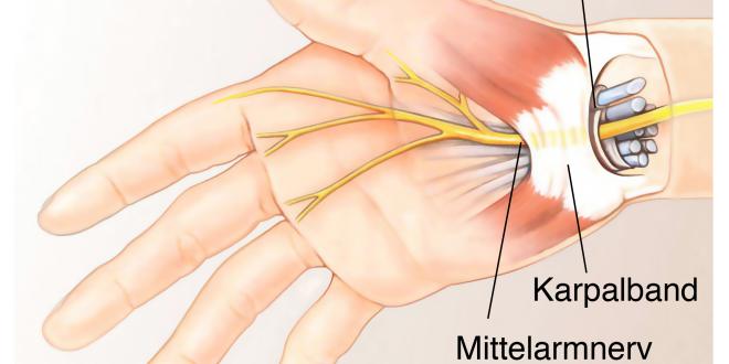 Mittelarmnerv