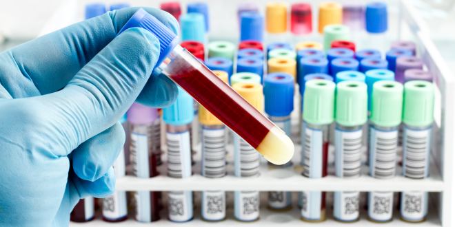 Hepatitis C Schnelltest