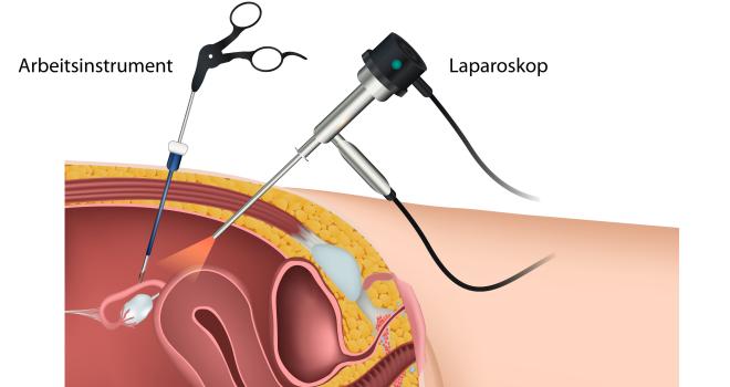 Laparoskopie