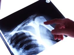Röntgen Schulter und Schlüsselbein
