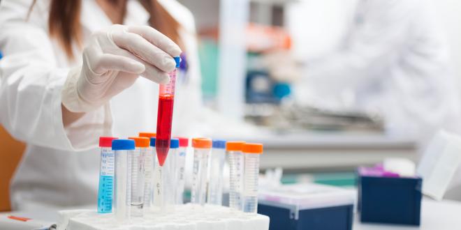 Der Hepatitis C Test wird im Labor ausgewertet.
