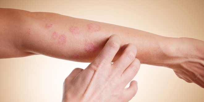 allergische Reaktion am Arm