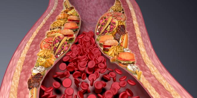 Arterienverkalkung