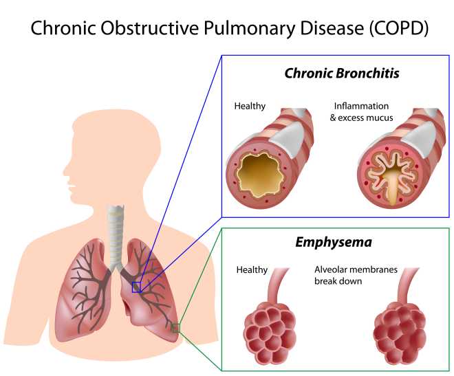 COPD COPD
