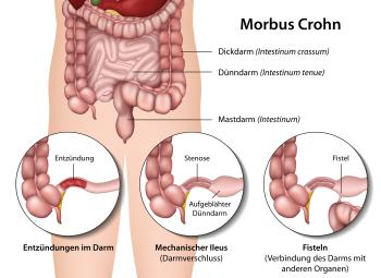 Schub eines Morbus Crohn