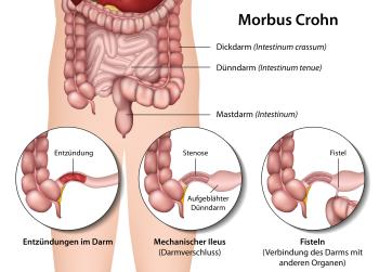 Komplikationen bei Morbus Crohn Schub eines Morbus Crohn