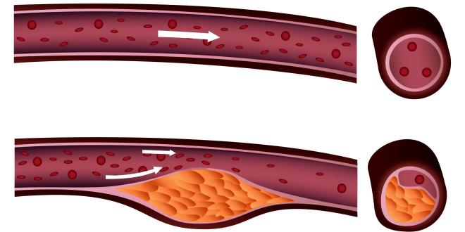 Arteriosklerose Symptome