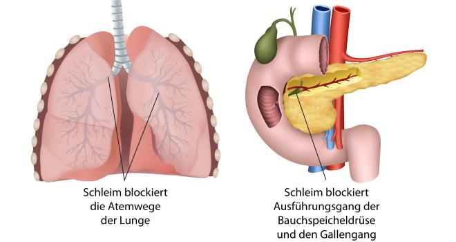 Zystische Fibrose