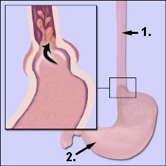 Schematische Darstellung Sodbrennen