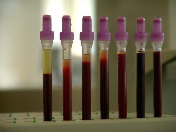 Wie erkennt man Leukämie im Blut Leukämie Blutbild