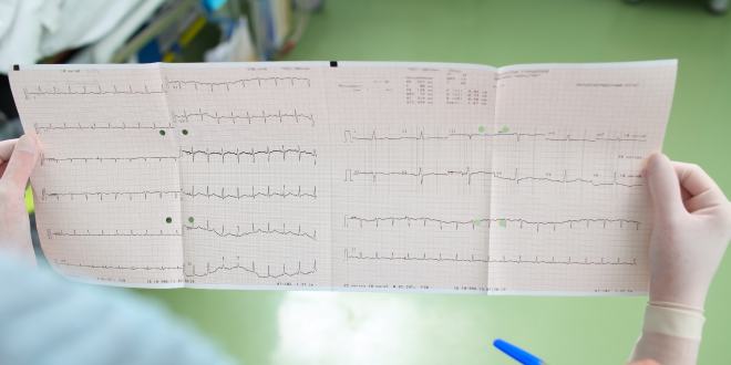 EKG mit Herzrhythmusstörungen