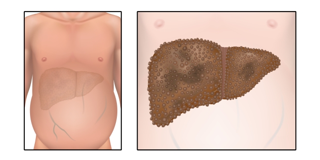 Abbildungen der Leber im Abdomen und der Leberzirrhose