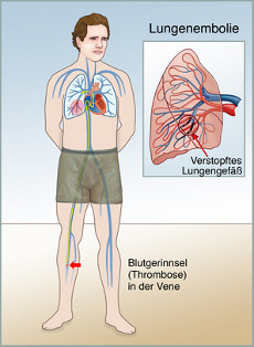 Lungenembolie Anzeichen