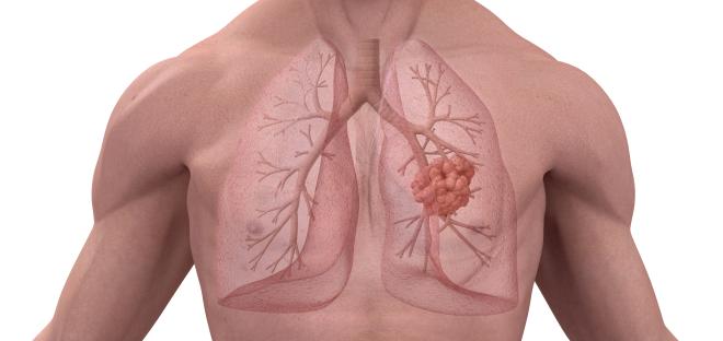 Schematische Projektion einer Lunge mit Emphysem auf einen männlichen Oberkörper