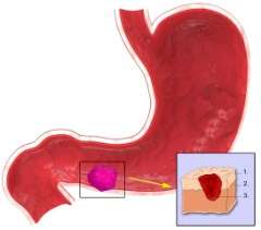 Anatomie des Magens beim Magengeschwür