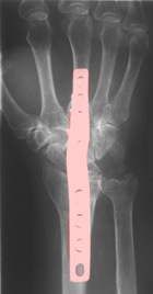 Handgelenksversteifung mittels Platte Arthrodese bei rheumatoider Arthritis