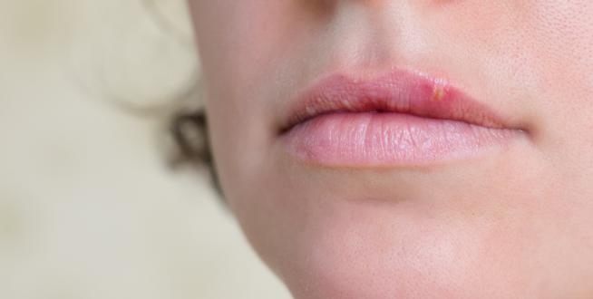 Pencivir bei Lippenherpes