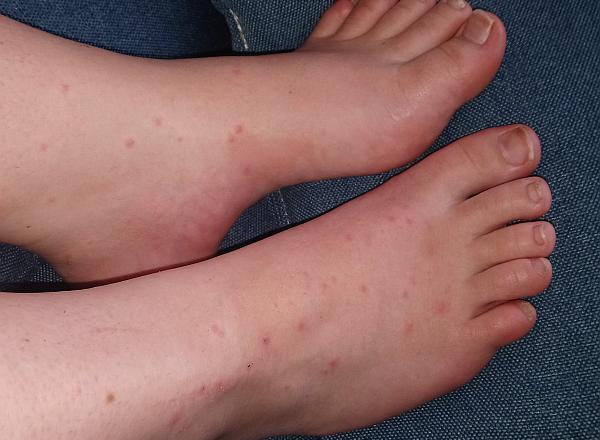 Rote Flecken an den Beinen Rote Flecken an den Beinen