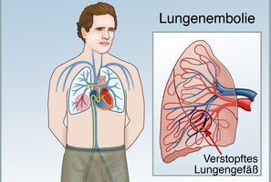 Test Lungenembolie