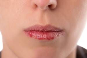 Test trockene Lippen