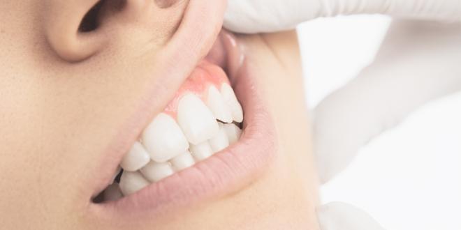 Pocht zahnfleisch pulsierende Zahnschmerzen