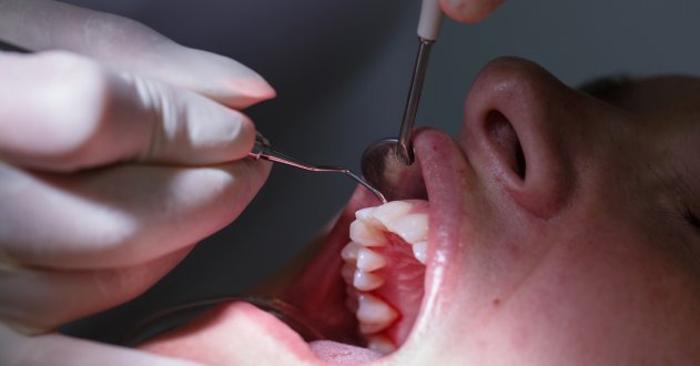 Zahn Nerv Ziehen