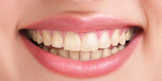 Grau zahn wird Zahn, Zahnfarbe,