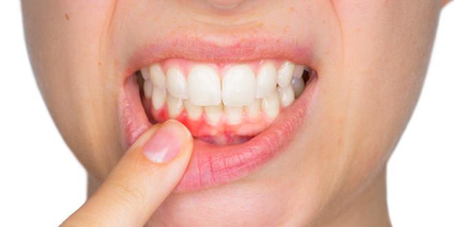 Zahnfleischentzündungen treten recht häufig auf.