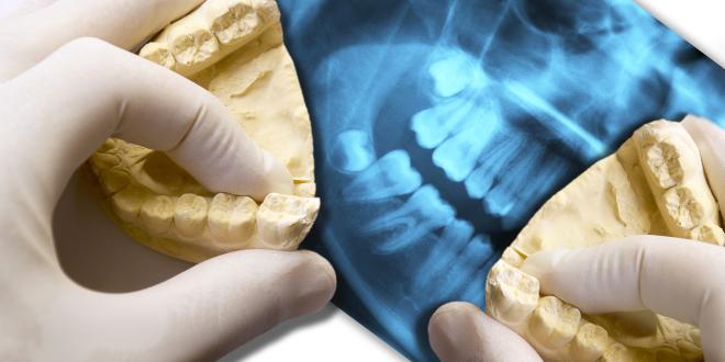 Geschwollen weisheitszahn Zahnfleischtaschen: Zahntaschenbehandlung