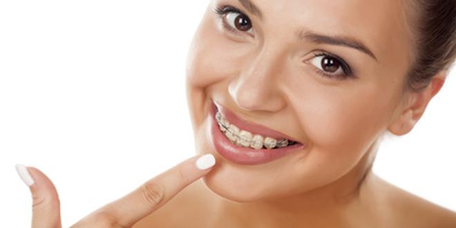 Brackets sind ein Hauptbestandteil der festen Zahnspange.
