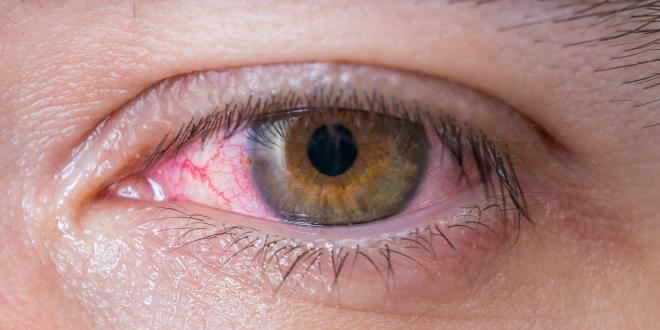 Augenerkrankungen durch Autoimmunerkranmkungen - gerötetes Auge