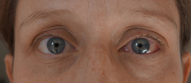 Bindehautentzündung des linken Auges