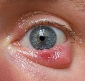 Ursachen Augenlidentzündung