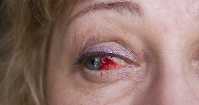 Hornhautentzündung Keratitis