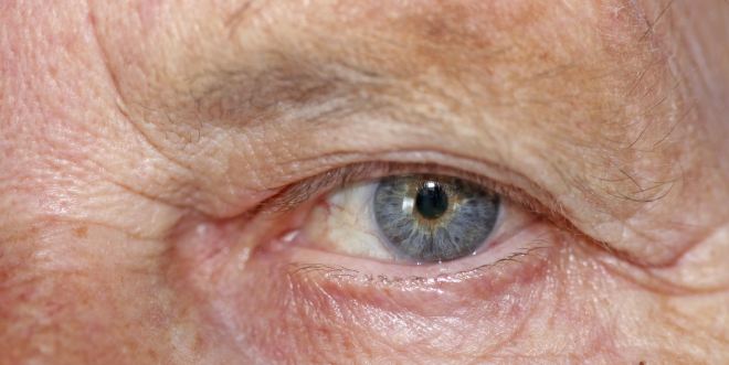 Schlupflider können zu einer Beeinträchtigung des Sehvermögens führen.