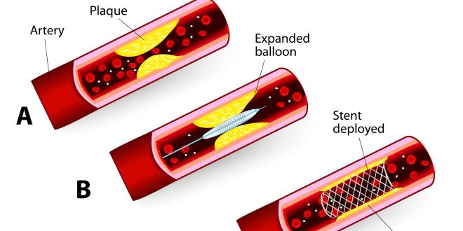 Stent