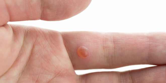 Finger immer am wieder herpes Periodisch auftretender