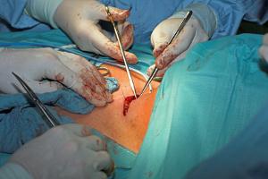Hauttransplantation Operation