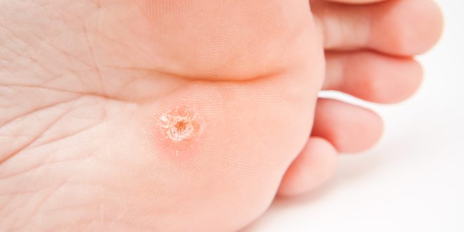 Der kleine eichel an bläschen Penispilz: Candidose