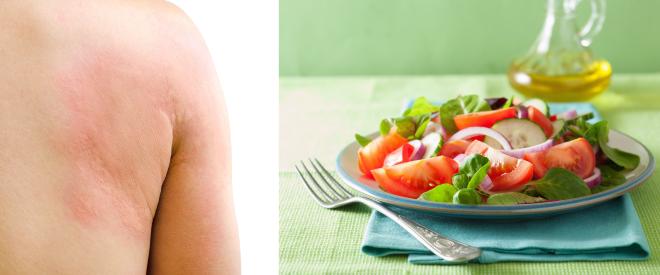 Es kann infolge des Konsums von rohen und verarbeiteten Tomaten zu Hautausschlägen kommen.